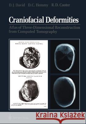 Craniofacial Deformities: Atlas of Three-Dimensional Reconstruction from Computed Tomography David, David J. 9781461279266 Springer - książka