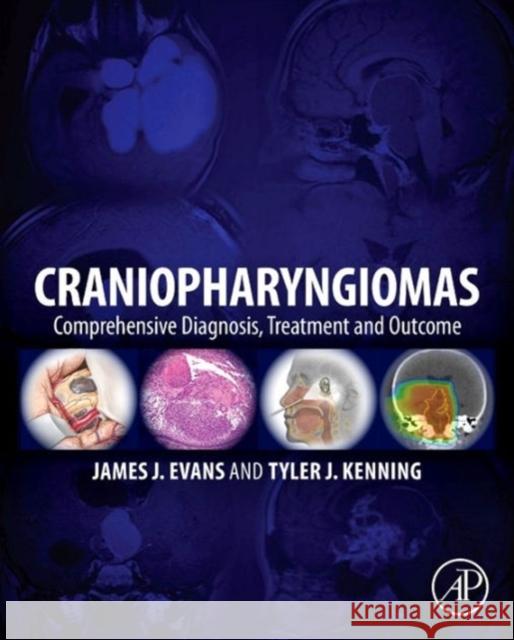 Craniopharyngiomas: Comprehensive Diagnosis, Treatment and Outcome Evans, James J. 9780124167063 Academic Press - książka