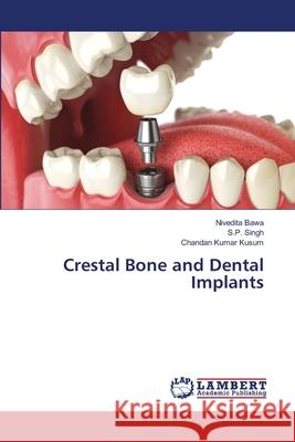 Crestal Bone and Dental Implants Bawa, Nivedita; Singh, S.P.; Kumar Kusum, Chandan 9786139577293 LAP Lambert Academic Publishing - książka