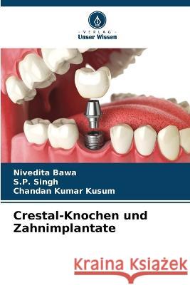 Crestal-Knochen und Zahnimplantate Nivedita Bawa, S P Singh, Chandan Kumar Kusum 9786205368954 Verlag Unser Wissen - książka