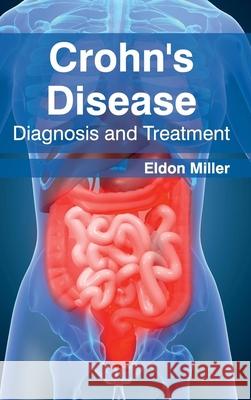 Crohn's Disease: Diagnosis and Treatment Eldon Miller 9781632420978 Foster Academics - książka