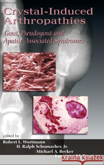 Crystal-Induced Arthropathies: Gout, Pseudogout and Apatite-Associated Syndromes Wortmann, Robert L. 9780849393822 Informa Healthcare - książka