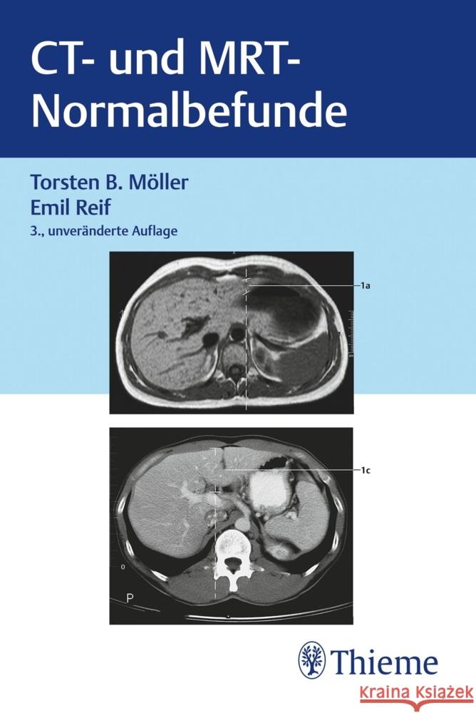 CT und MRT Normalbefunde Möller, Torsten Bert, Reif, Emil 9783132453074 Thieme, Stuttgart - książka