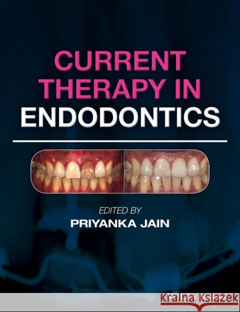 Current Therapy in Endodontics Priyanka Jain 9781119067559 Wiley-Blackwell - książka