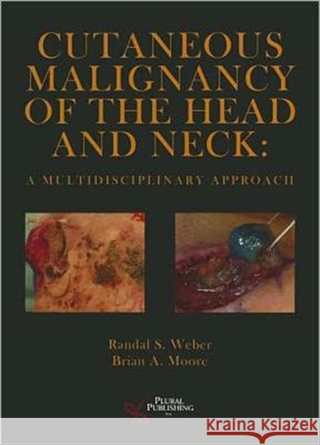 Cutaneous Malignancy of the Head and Neck: A Multidisciplinary Approach Weber, Randal S., Ed 9781597563383 Plural Publishing - książka