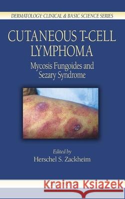 Cutaneous T-Cell Lymphoma: Mycosis Fungoides and Sezary Syndrome Zackheim, Herschel S. 9780849321016 CRC Press - książka