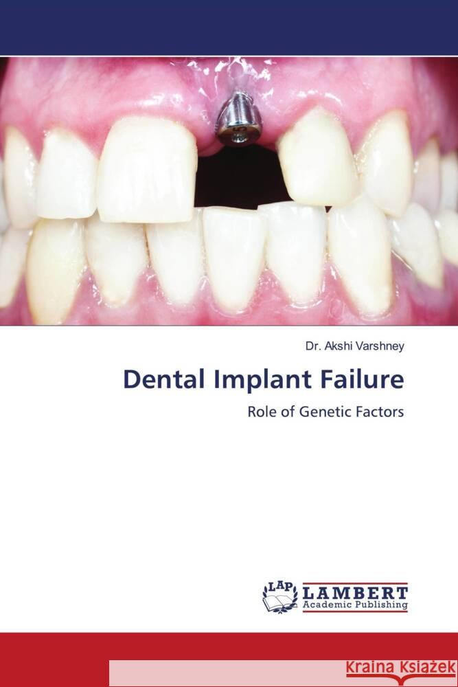 Dental Implant Failure Akshi Varshney 9786207456345 LAP Lambert Academic Publishing - książka