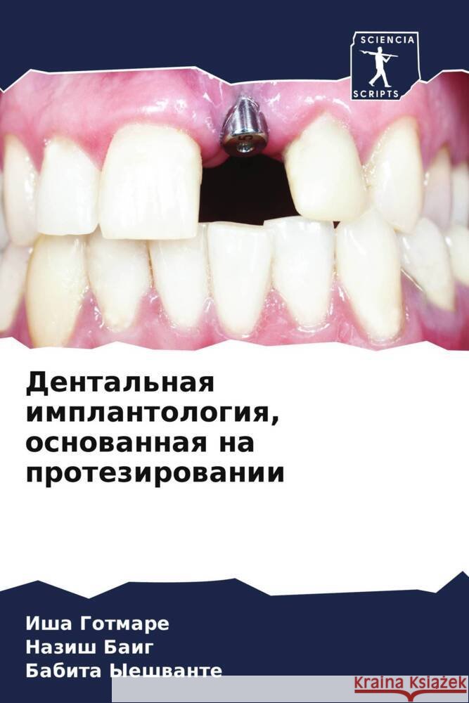 Dental'naq implantologiq, osnowannaq na protezirowanii Gotmare, Isha, Baig, Nazish, Yeshwante, Babita 9786207077892 Sciencia Scripts - książka