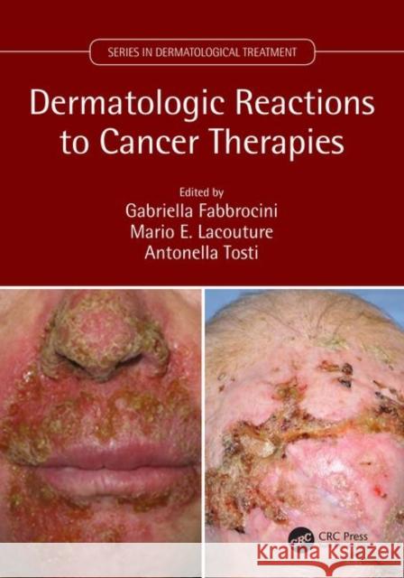 Dermatologic Reactions to Cancer Therapies Gabriella Fabbrocini Mario E. Lacouture Antonella Tosti 9781138035539 CRC Press - książka