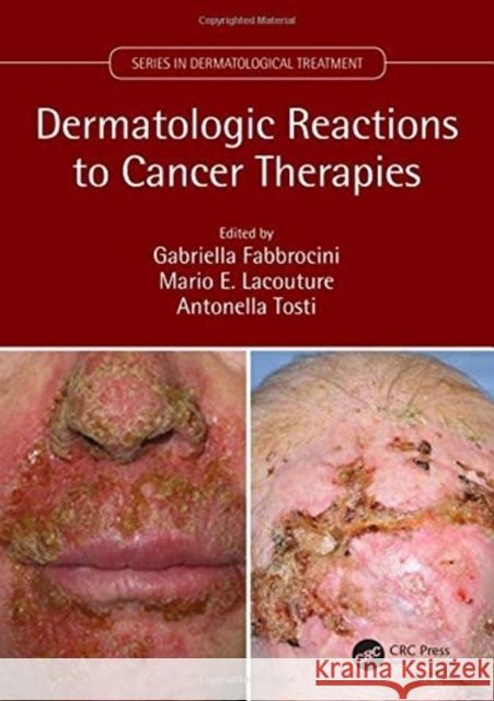 Dermatologic Reactions to Cancer Therapies Gabriella Fabbrocini Mario E. Lacouture Antonella Tosti 9781138633254 CRC Press - książka