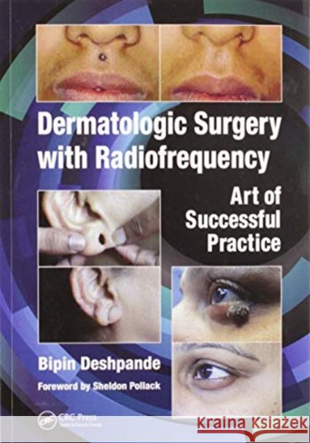 Dermatologic Surgery with Radiofrequency: Art of Successful Practice Bipin Deshpande 9780367571672 CRC Press - książka