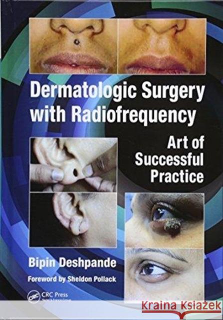 Dermatologic Surgery with Radiofrequency: Art of Successful Practice Bipin Deshpande 9781138301146 CRC Press - książka