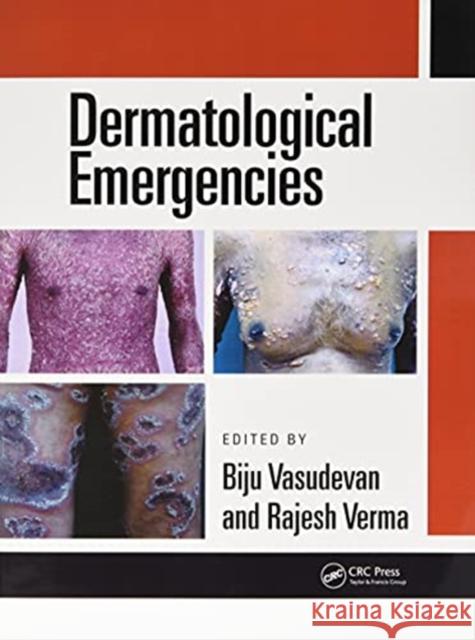 Dermatological Emergencies Rajesh Verma Biju Vasudevan 9780367778606 CRC Press - książka