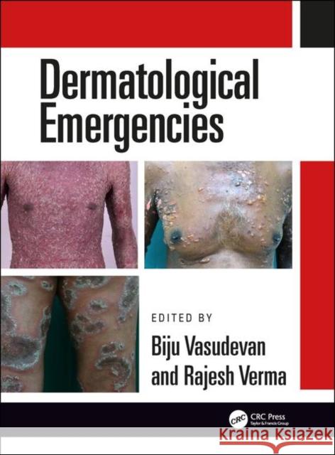 Dermatological Emergencies Rajesh Verma Biju Vasudevan 9780815378075 CRC Press - książka