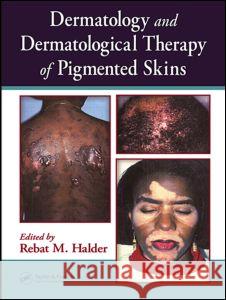 Dermatology and Dermatological Therapy of Pigmented Skins Steven Strauss Halder Rebat                             Halder Halder 9780849314025 CRC Press - książka