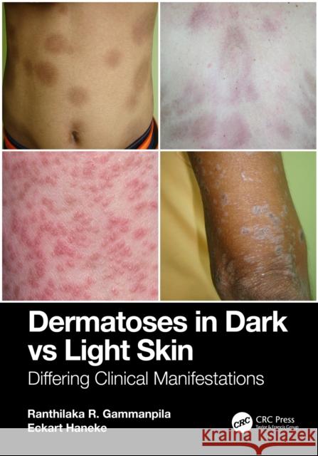 Dermatoses in Dark Vs Light Skin: Differing Clinical Manifestations Ranthilaka R. Gammanpila Eckart Haneke 9781032762739 CRC Press - książka