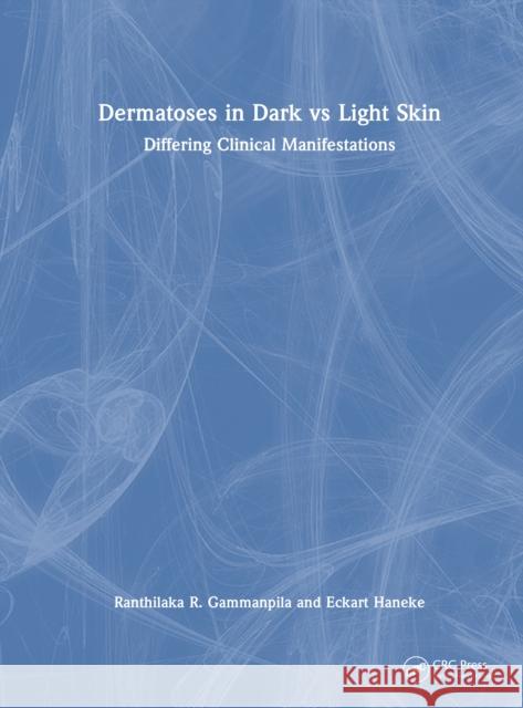 Dermatoses in Dark Vs Light Skin: Differing Clinical Manifestations Ranthilaka R. Gammanpila Eckart Haneke 9781032766638 CRC Press - książka