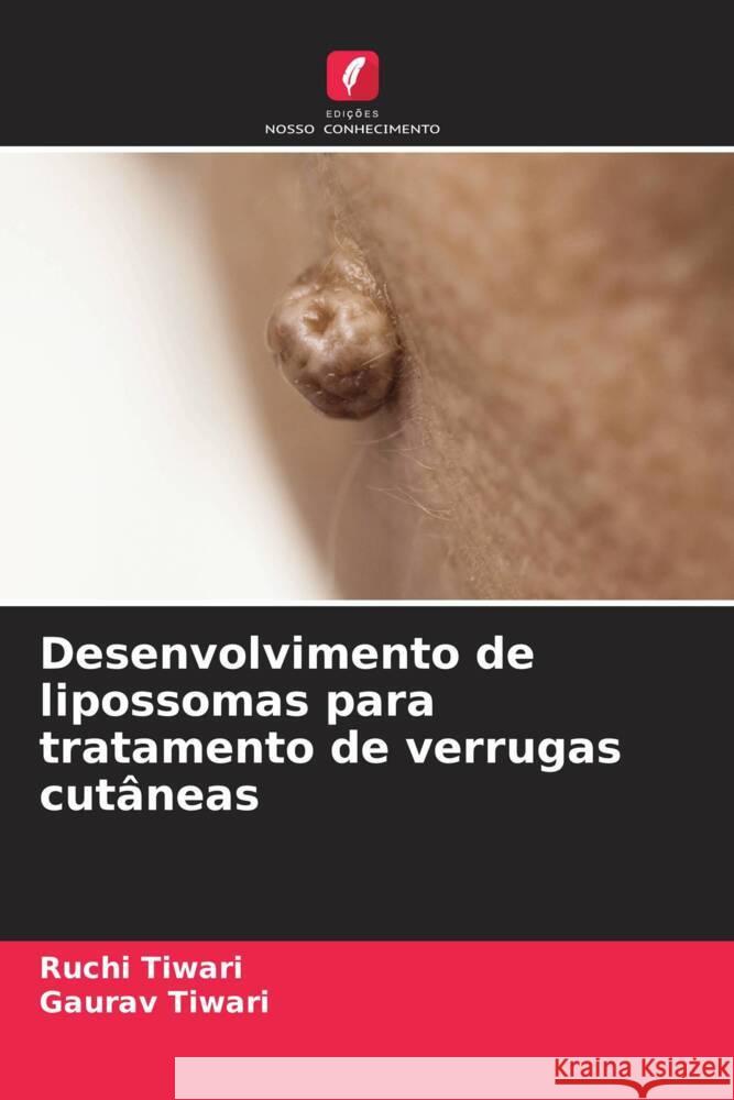 Desenvolvimento de lipossomas para tratamento de verrugas cutâneas Tiwari, Ruchi, Tiwari, Gaurav 9786205085110 Edições Nosso Conhecimento - książka