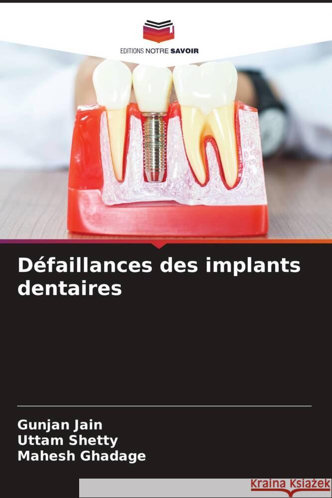 Défaillances des implants dentaires Jain, Gunjan, Shetty, Uttam, Ghadage, Mahesh 9786205065693 Editions Notre Savoir - książka