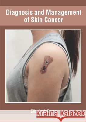 Diagnosis and Management of Skin Cancer Elizabeth Burns 9781632427472 Foster Academics - książka