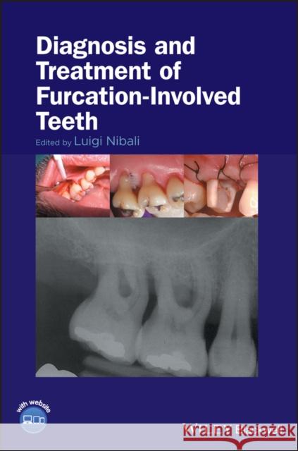Diagnosis and Treatment of Furcation-Involved Teeth Luigi Nibali 9781119270652 Wiley-Blackwell - książka