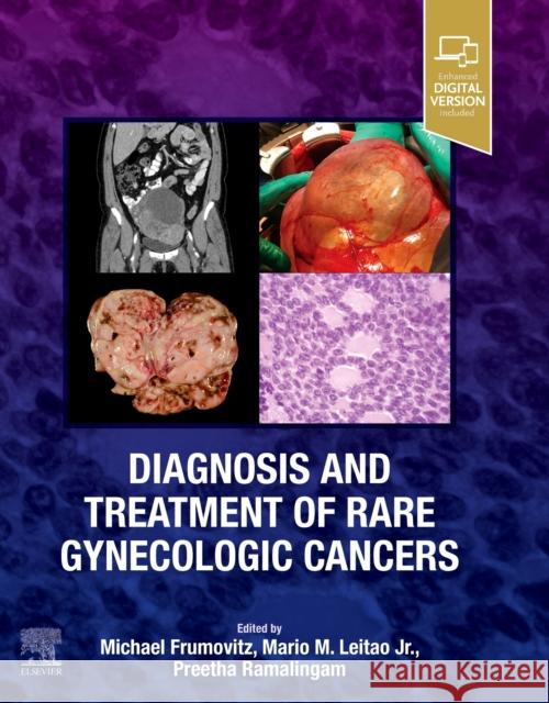 Diagnosis and Treatment of Rare Gynecologic Cancers Michael Frumovitz Mario Leitao Preetha Ramalingam 9780323829380 Elsevier - książka