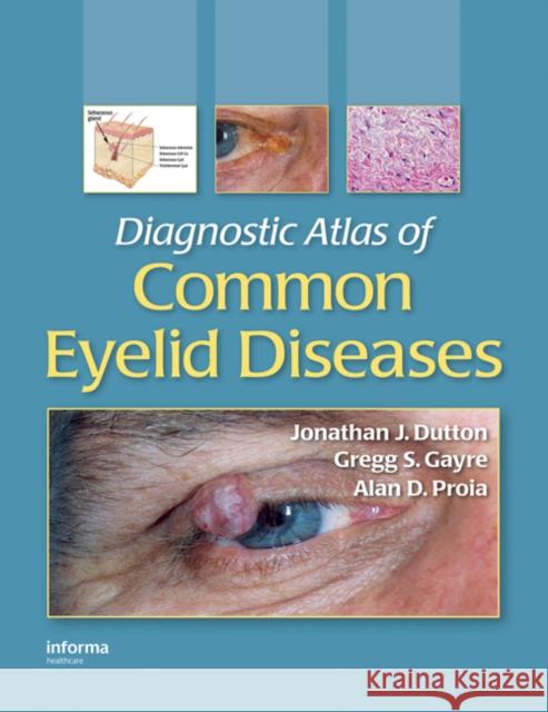 Diagnostic Atlas of Common Eyelid Diseases Jonathan J. Dutton Dutton J. Dutton Gregg S. Gayre 9780824728397 Informa Healthcare - książka
