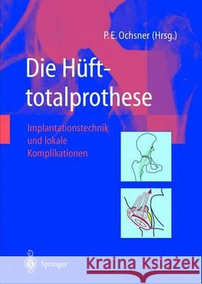 Die Hüfttotalprothese: Implantationstechnik Und Lokale Komplikationen Ochsner, Peter E. 9783642639432 Springer, Berlin - książka