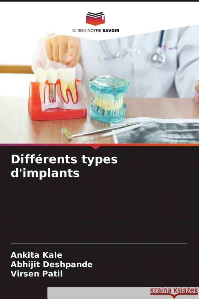 Différents types d'implants Kale, Ankita, Deshpande, Abhijit, Patil, Virsen 9786208212070 Editions Notre Savoir - książka