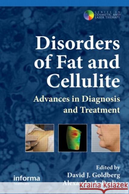 Disorders of Fat and Cellulite: Advances in Diagnosis and Treatment Goldberg, David J. 9780415477000 Informa Healthcare - książka