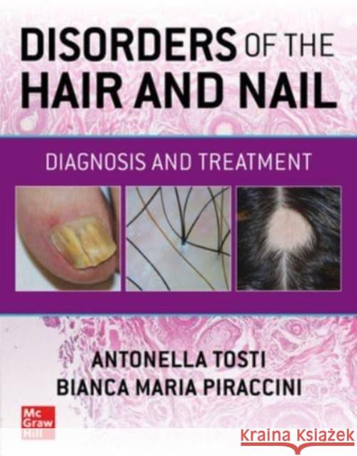 Disorders of the Hair and Nail: Diagnosis and Treatment Antonella Tosti Bianca Maria Piraccini 9781260462470 McGraw-Hill Education - książka