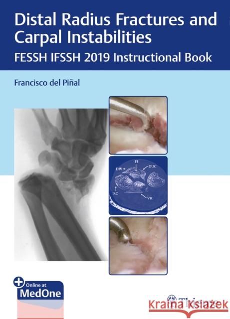 Distal Radius Fractures and Carpal Instabilities: Fessh Ifssh 2019 Instructional Book Pinal, Francisco 9783132423794 Thieme Medical Publishers - książka