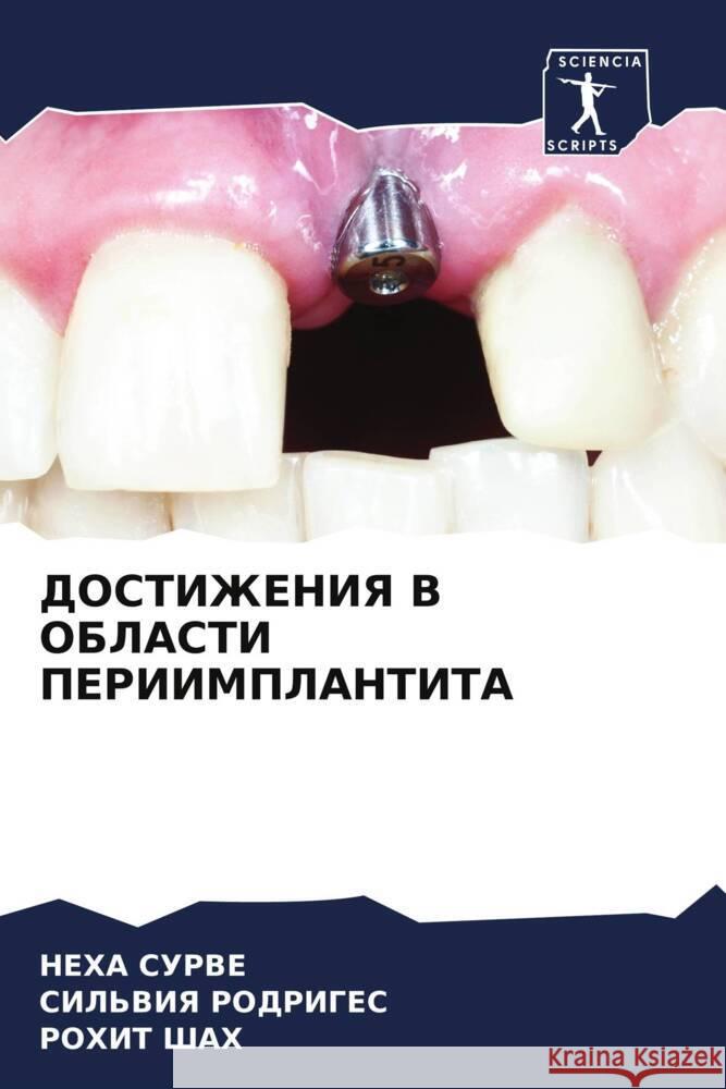 DOSTIZhENIYa V OBLASTI PERIIMPLANTITA SURVE, NEHA, Rodriges, Sil'wiq, Shah, Rohit 9786207096251 Sciencia Scripts - książka