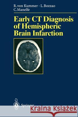 Early CT Diagnosis of Hemispheric Brain Infarction Rüdiger v. Kummer, Luigi Bozzao, Claude Manelfe, S. Bastianello, H. Zeumer 9783540600565 Springer-Verlag Berlin and Heidelberg GmbH &  - książka