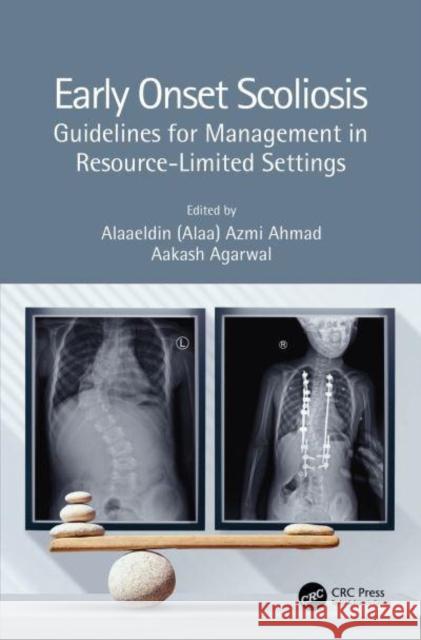 Early Onset Scoliosis: Guidelines for Management in Resource-Limited Settings Alaaeldin (Alaa) Azmi Ahmad (Annajah Uni Aakash Agarwal (University of Toledo, US  9780367676872 CRC Press - książka