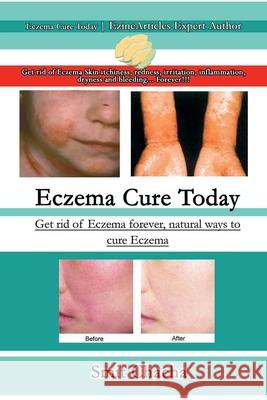 Eczema Cure Today - Get rid of Eczema forever natural ways to cure Eczema Chacha, Smit 9781387307982 Lulu.com - książka