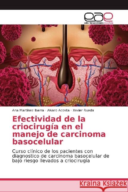 Efectividad de la criocirugía en el manejo de carcinoma basocelular : Curso clínico de los pacientes con diagnostico de carcinoma basocelular de bajo riesgo llevados a criocirugía Martínez Ibarra, Ana; Acosta, Alvaro; Rueda, Xavier 9783841751522 Editorial Académica Española - książka