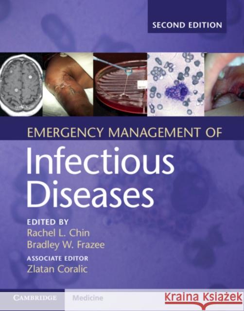 Emergency Management of Infectious Diseases Rachel L. Chin Zlatan Coralic Bradley W. Frazee 9781107153158 Cambridge University Press - książka