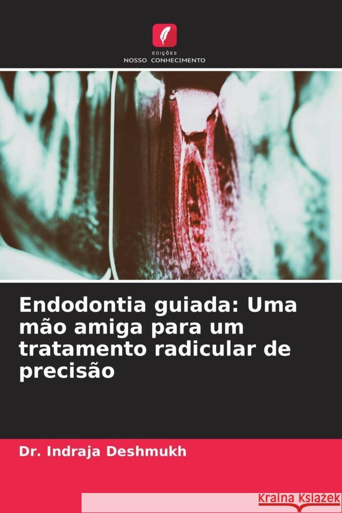 Endodontia guiada: Uma m?o amiga para um tratamento radicular de precis?o Indraja Deshmukh 9786208121990 Edicoes Nosso Conhecimento - książka