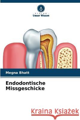 Endodontische Missgeschicke Megna Bhatt   9786205612972 Verlag Unser Wissen - książka