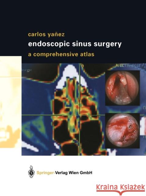 Endoscopic Sinus Surgery: A Comprehensive Atlas Yañez, Carlos 9783709172797 Springer - książka