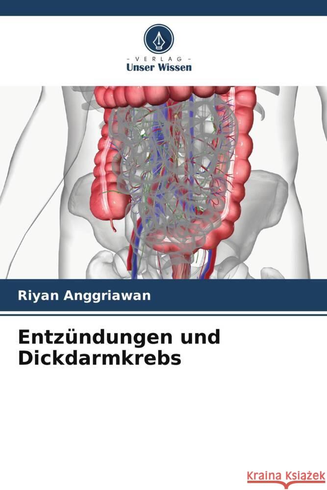 Entz?ndungen und Dickdarmkrebs Riyan Anggriawan 9786206620389 Verlag Unser Wissen - książka