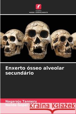Enxerto ósseo alveolar secundário Tanneru, Nagaraju, Vura, Nanda Gopal 9786208724481 Edições Nosso Conhecimento - książka