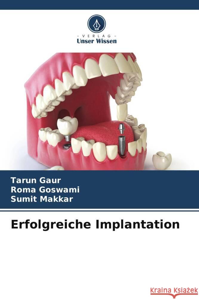 Erfolgreiche Implantation Gaur, Tarun, Goswami, Roma, Makkar, Sumit 9786202673860 Verlag Unser Wissen - książka