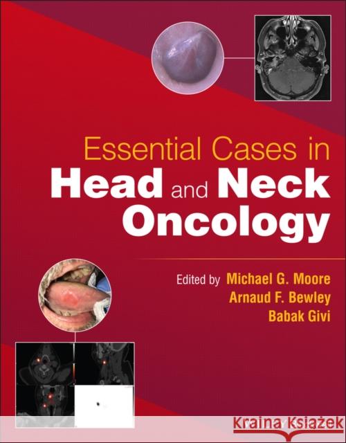 Essential Cases in Head and Neck Oncology Babak Givi Michael G. Moore Arnaud F. Bewley 9781119775942 Wiley - książka
