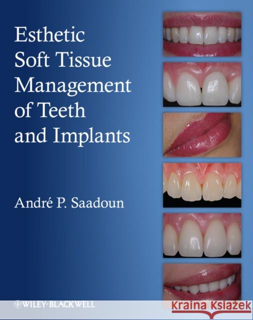 Esthetic Soft Tissue Management of Teeth and Implants Andre P. Saadoun 9781118301159 Wiley-Blackwell - książka