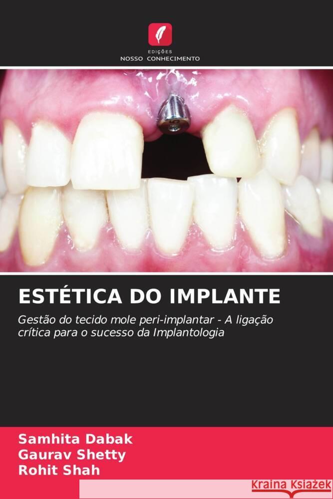 ESTÉTICA DO IMPLANTE Dabak, Samhita, Shetty, Gaurav, Shah, Rohit 9786204560922 Edições Nosso Conhecimento - książka