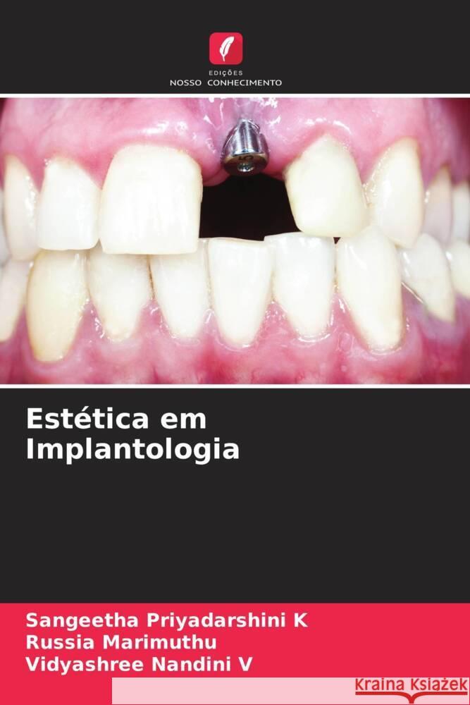Estética em Implantologia K, Sangeetha Priyadarshini, Marimuthu, Russia, V, Vidyashree Nandini 9786206393436 Edições Nosso Conhecimento - książka