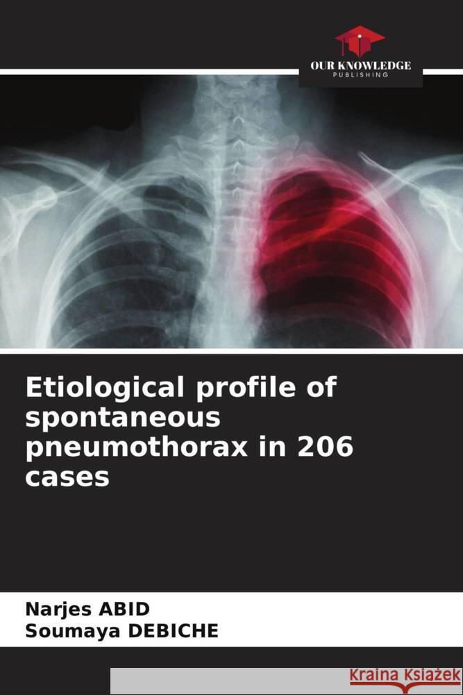 Etiological profile of spontaneous pneumothorax in 206 cases Abid, Narjes, Debiche, Soumaya 9786208382506 Our Knowledge Publishing - książka