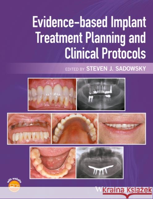 Evidence-Based Implant Treatment Planning and Clinical Protocols Sadowsky, Steven J. 9781119080039 Wiley-Blackwell - książka